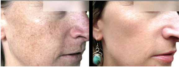 Before and after results of Moxi BBL Heroic, Look Timeless Medical Spa, Markham, Ontario
