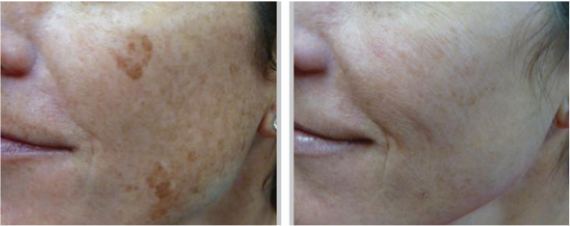 Before and after results of Moxi BBL Heroic, Look Timeless Medical Spa, Markham, Ontario